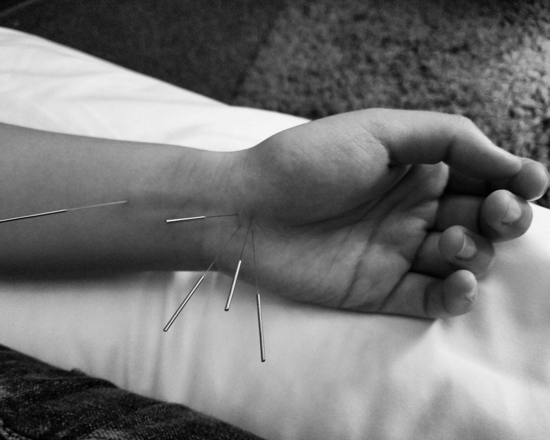 Wrist Pain Acupuncture